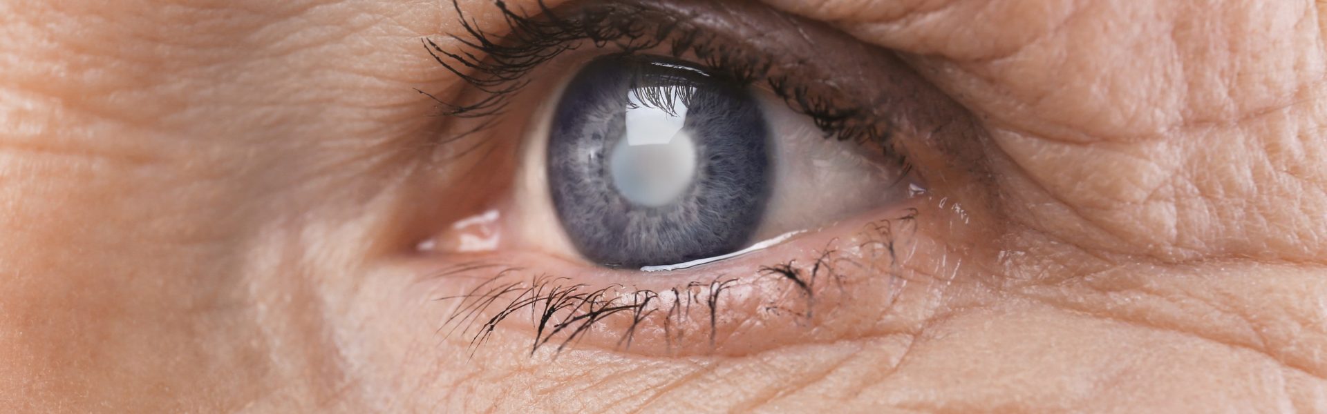 What are Cataracts? banner